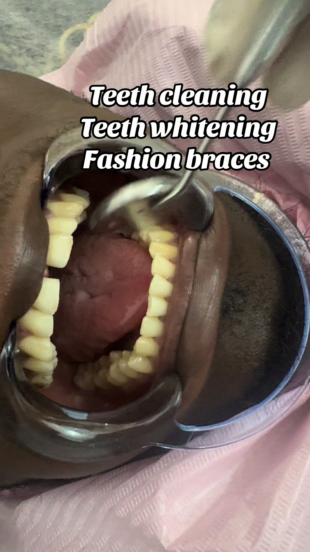 @Teethwhitening—MartGlow Avenue