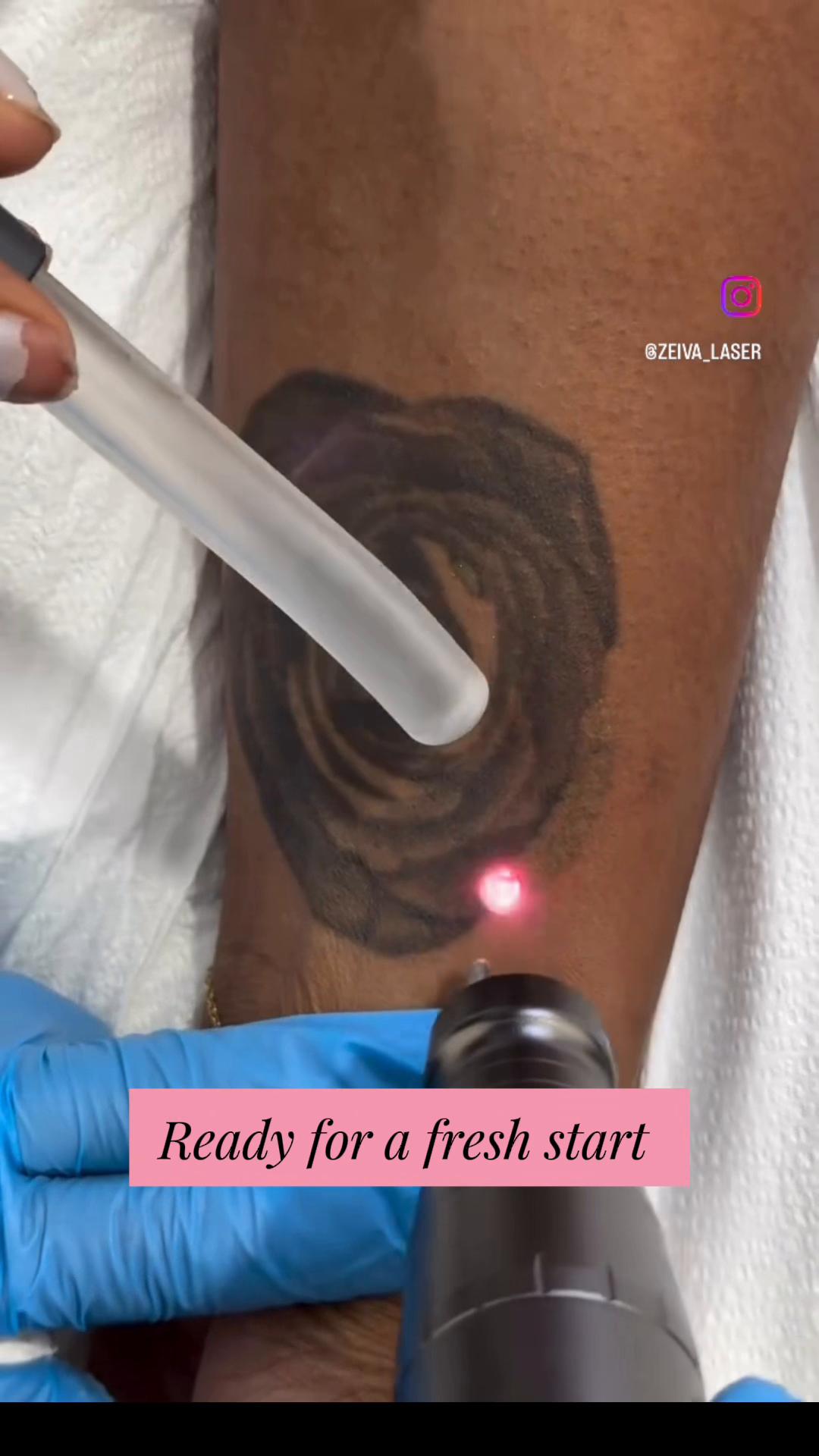@Zeiva laser /Dearborn MI