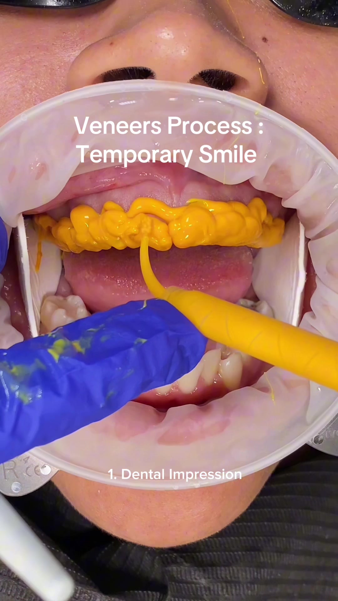 @Veneers