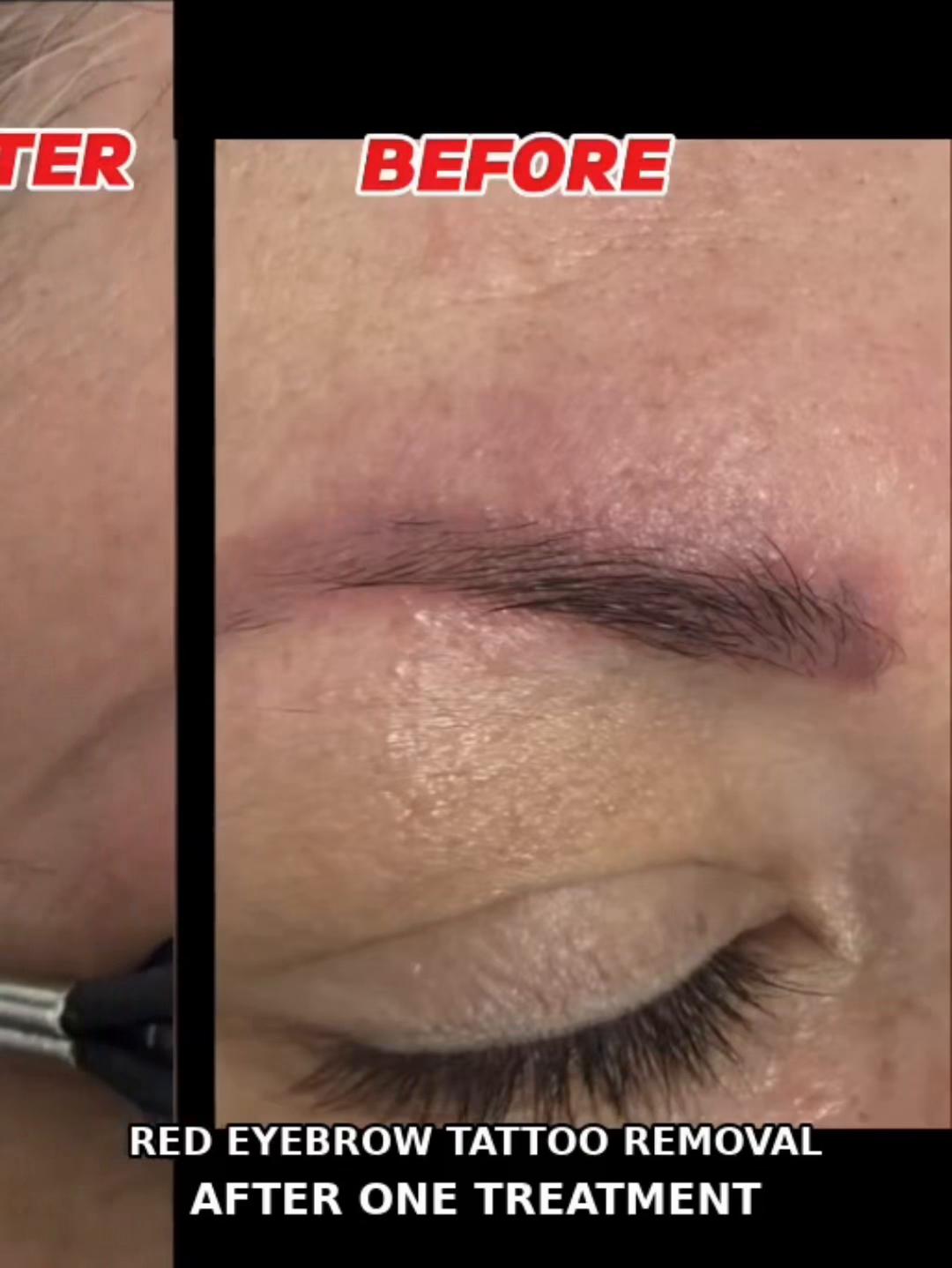 @Zeiva laser /Dearborn MI