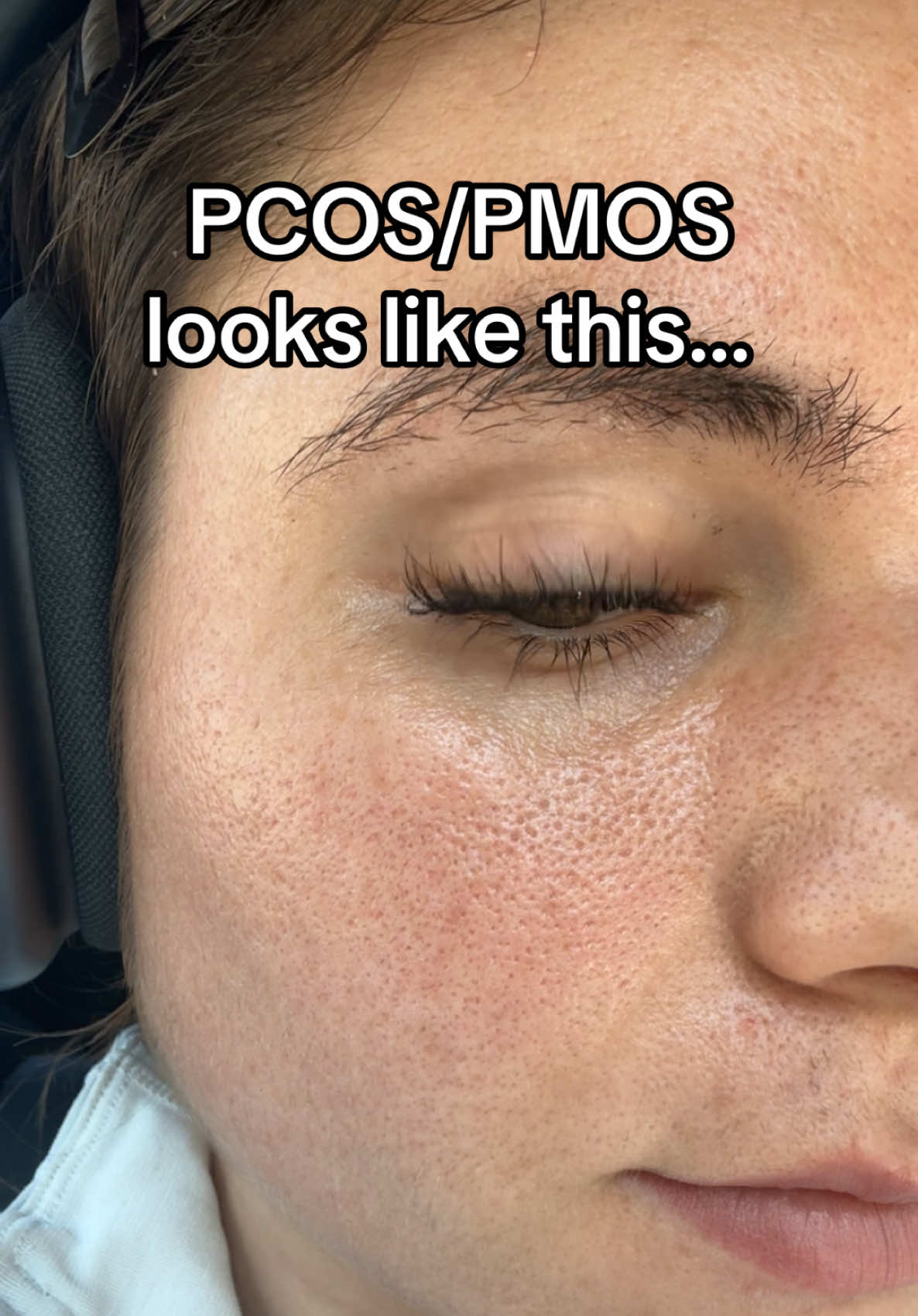 @Sarah | PMOS/PCOS life + tips