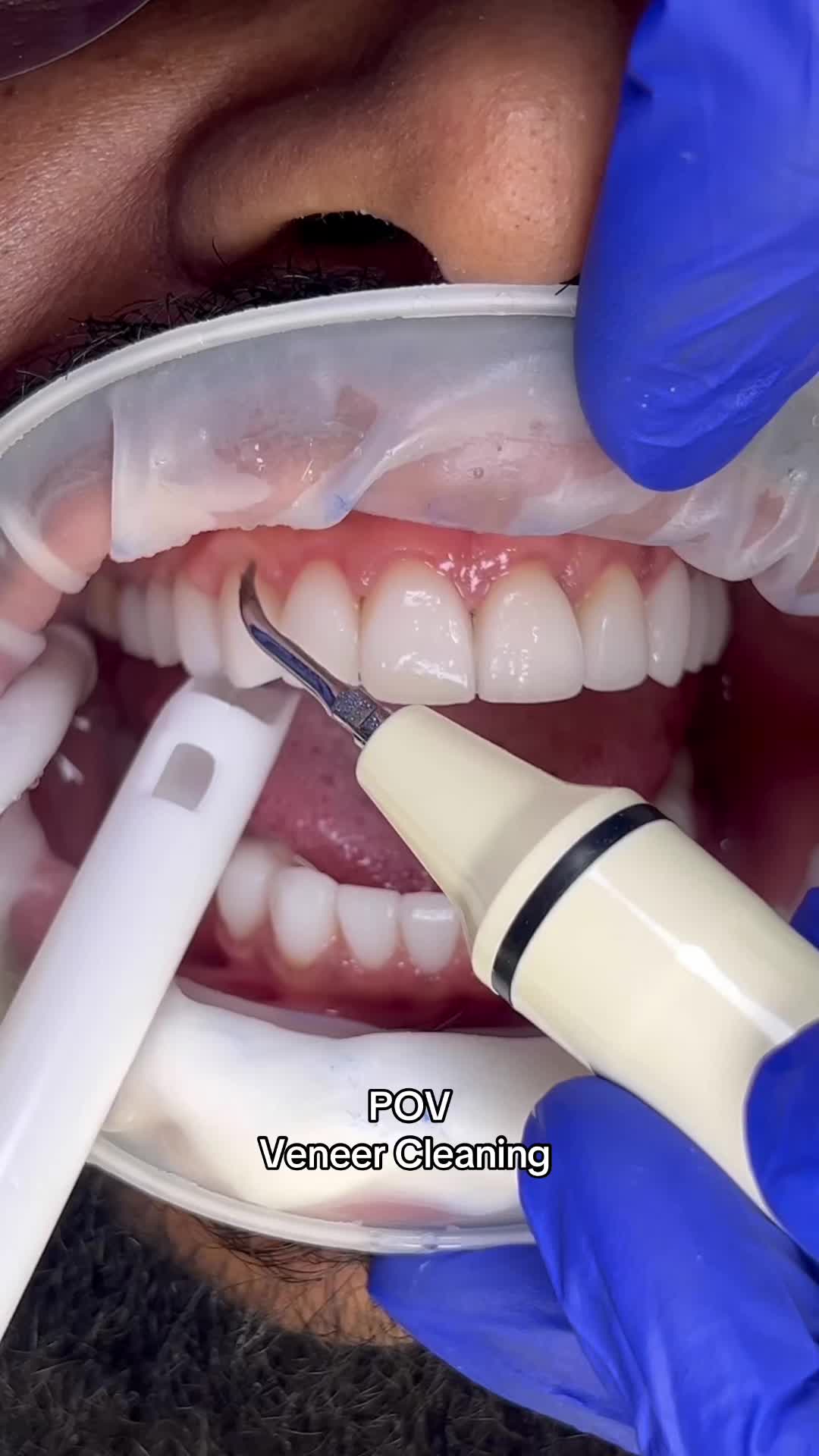 @Veneers