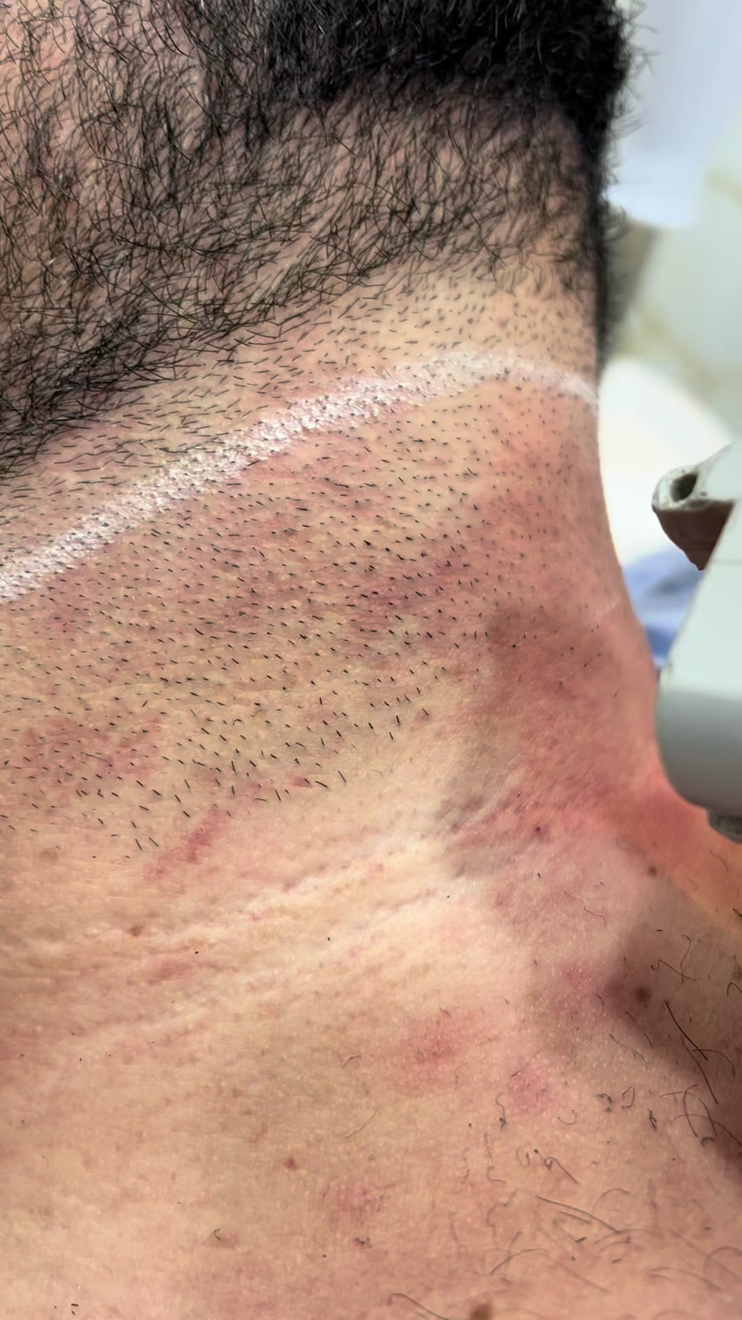 @Laser Grafix clinic
