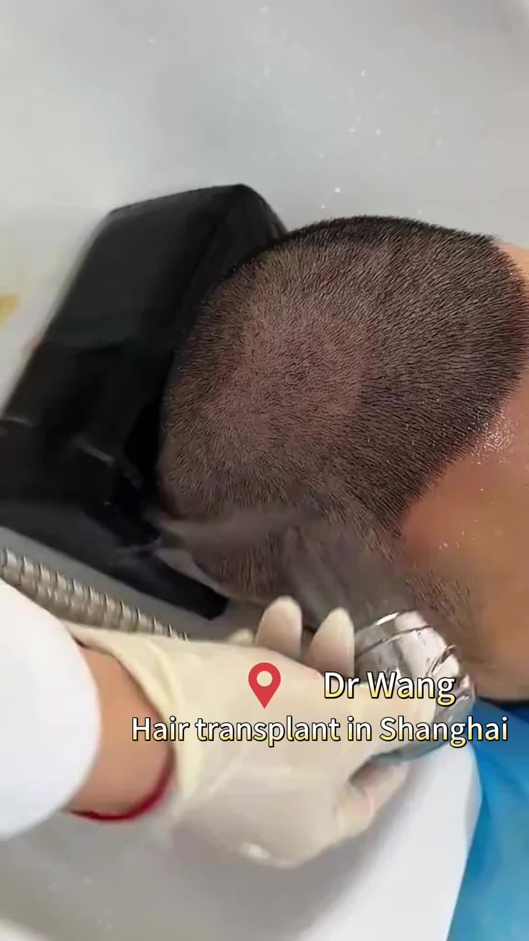@HAIR TRANSPLANT WANG🇨🇳