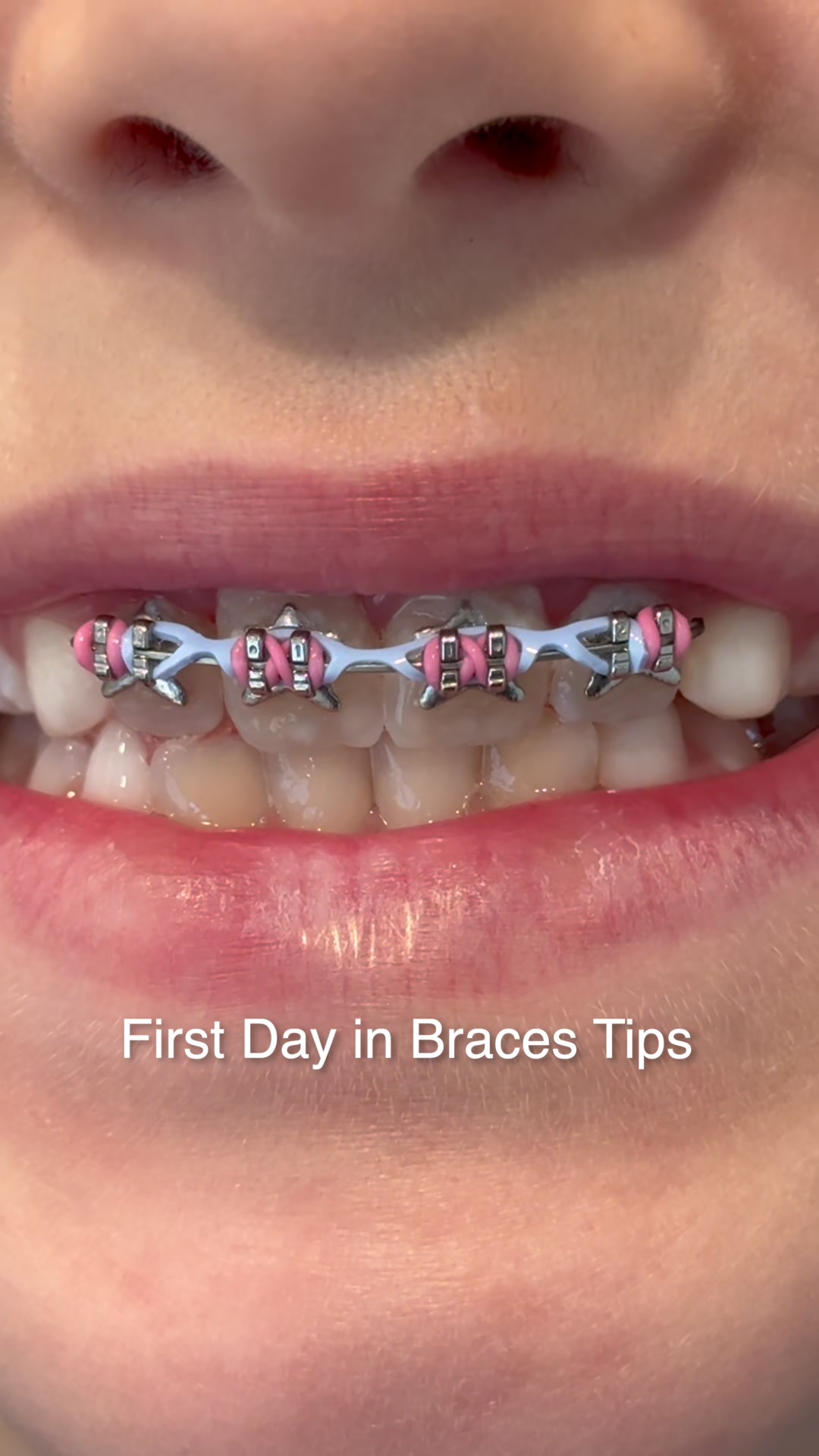 @The Braces Guy