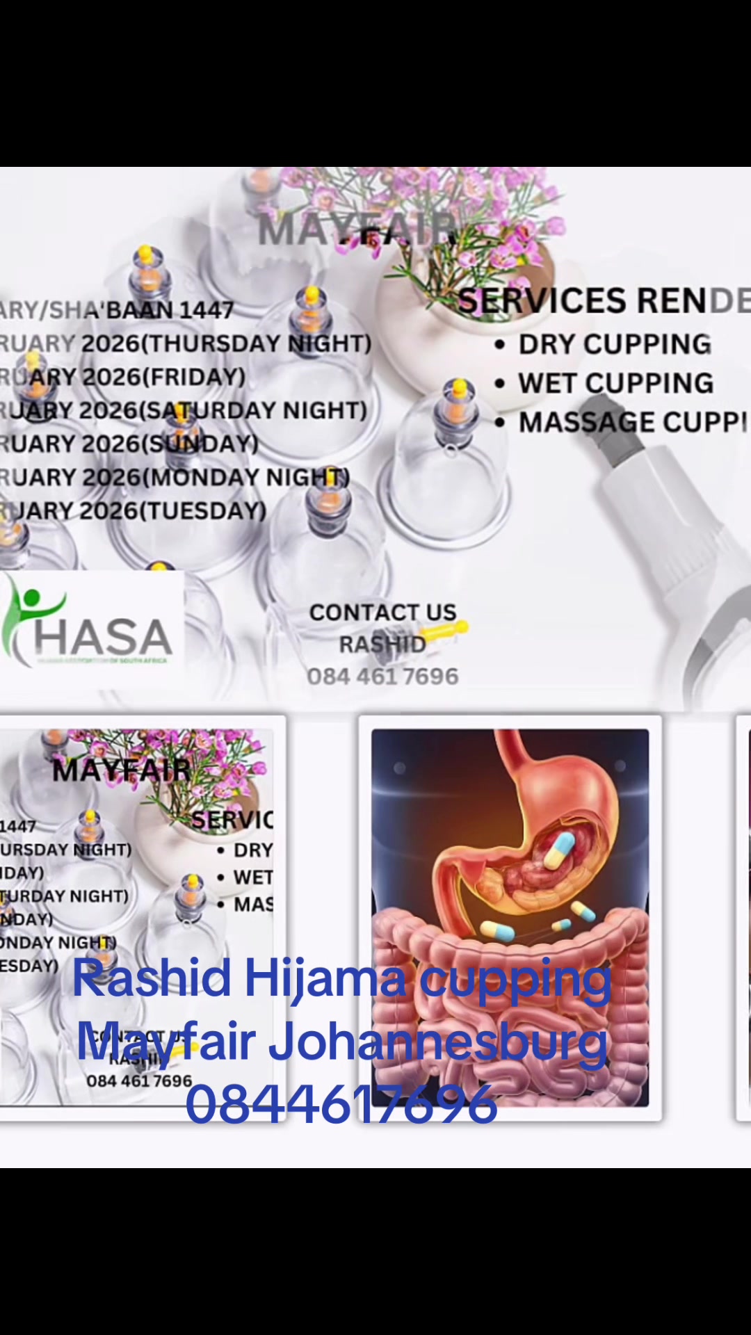 @Rashid 🇿🇦 🇵🇰Hijama Cupping