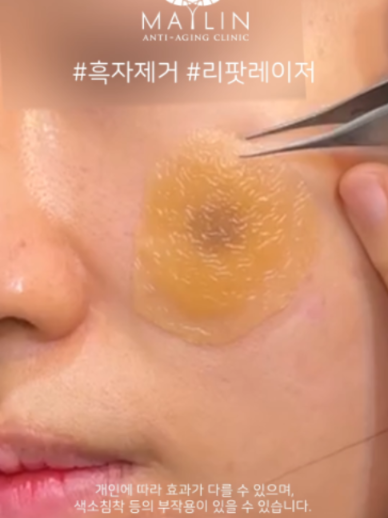 @메이린의원대구점