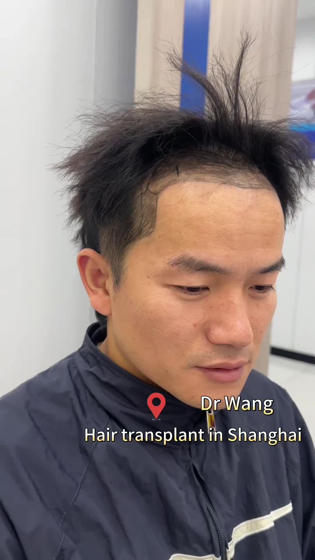 @HAIR TRANSPLANT WANG🇨🇳