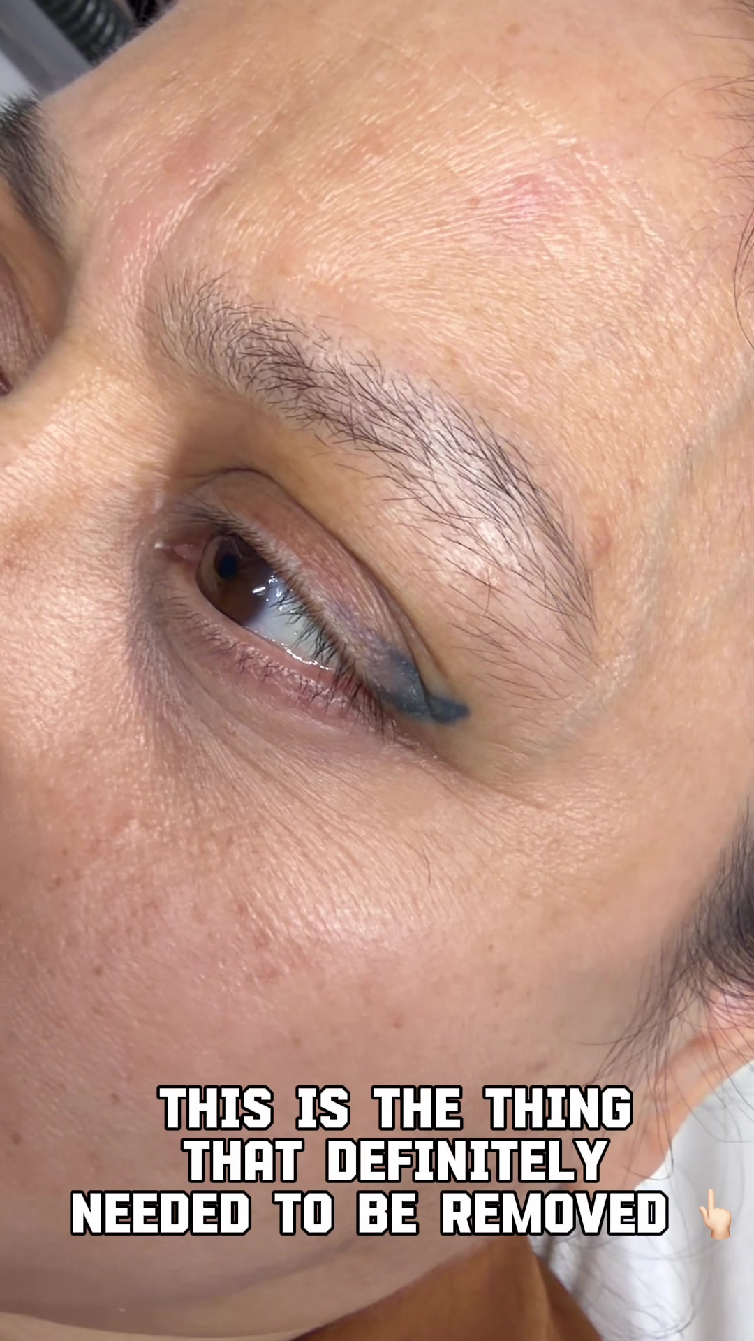 @Safe Eyebrows Tattoo Removal🗽