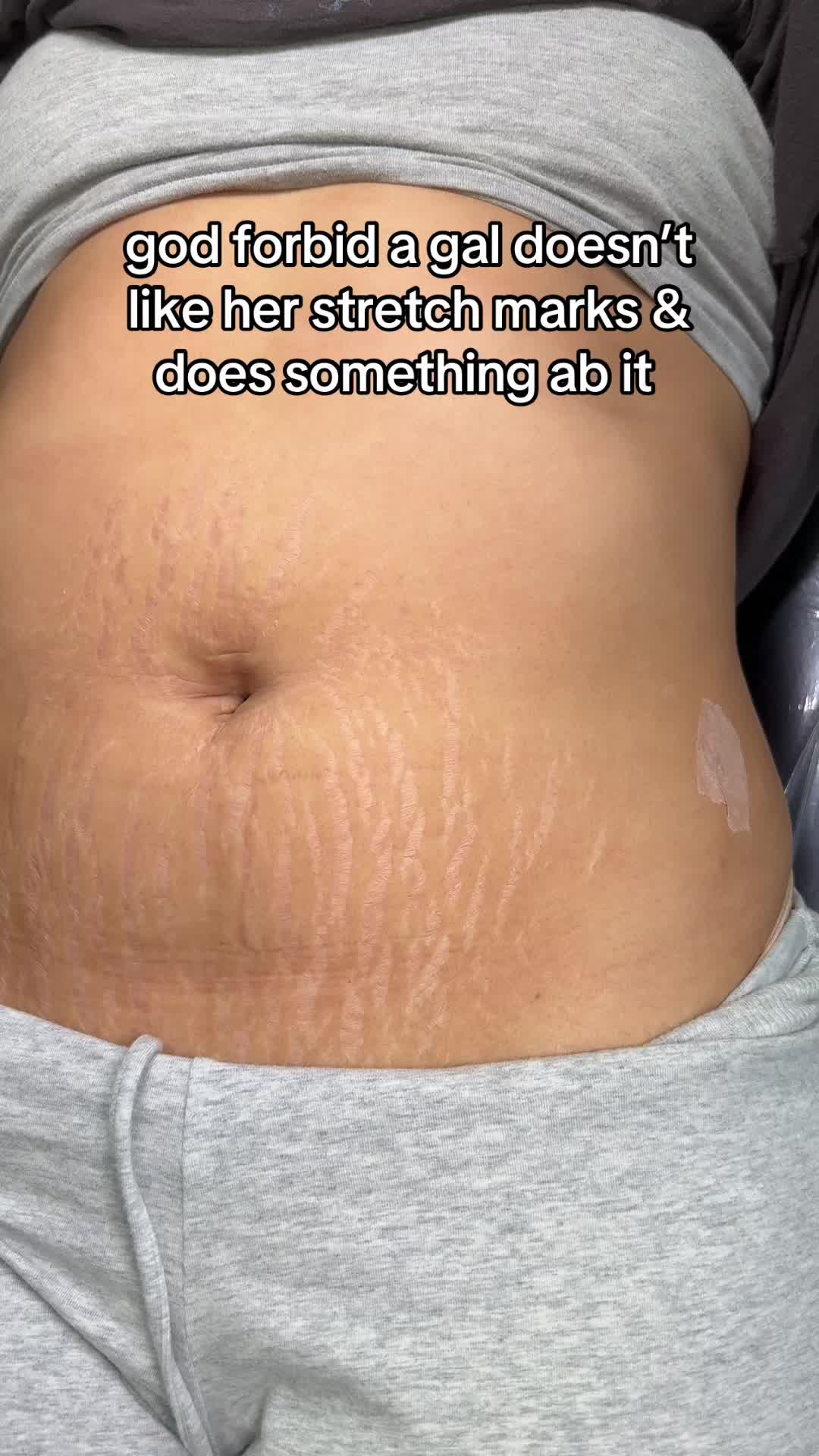 @Stretch Mark Fairy 🧚✨