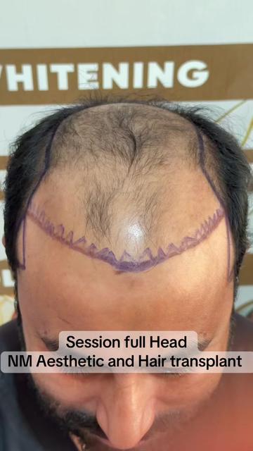 @Naveed Marwat HairTrnsplant