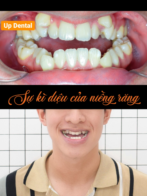@Nha khoa niềng răng Up Dental