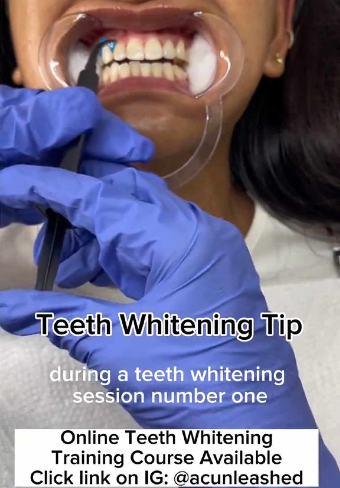 @Diandra | Teeth Whitening Tech