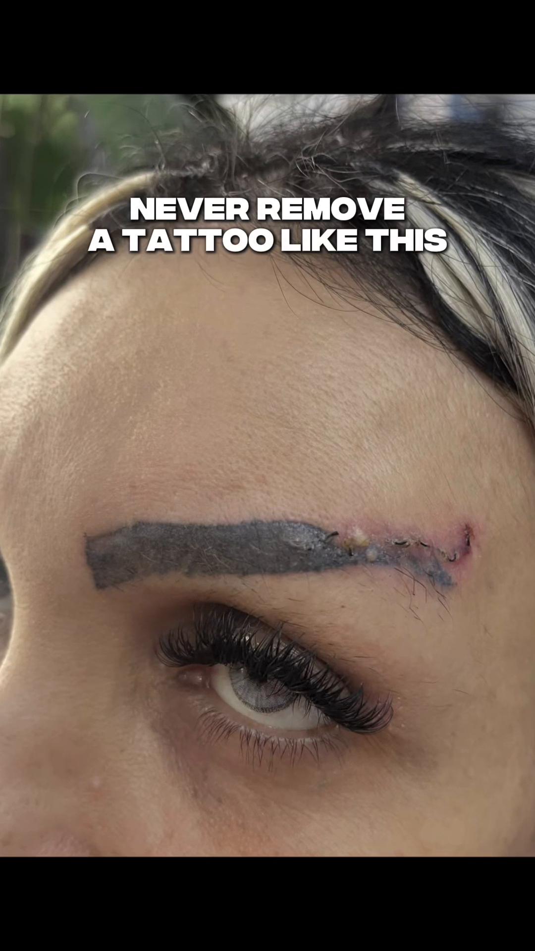 @Safe Eyebrows Tattoo Removal🗽