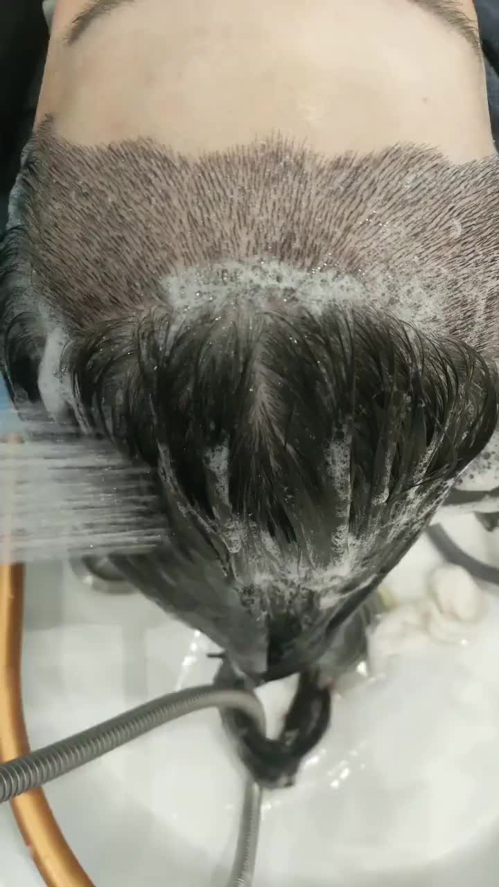 @HAIR TRANSPLANT WANG🇨🇳