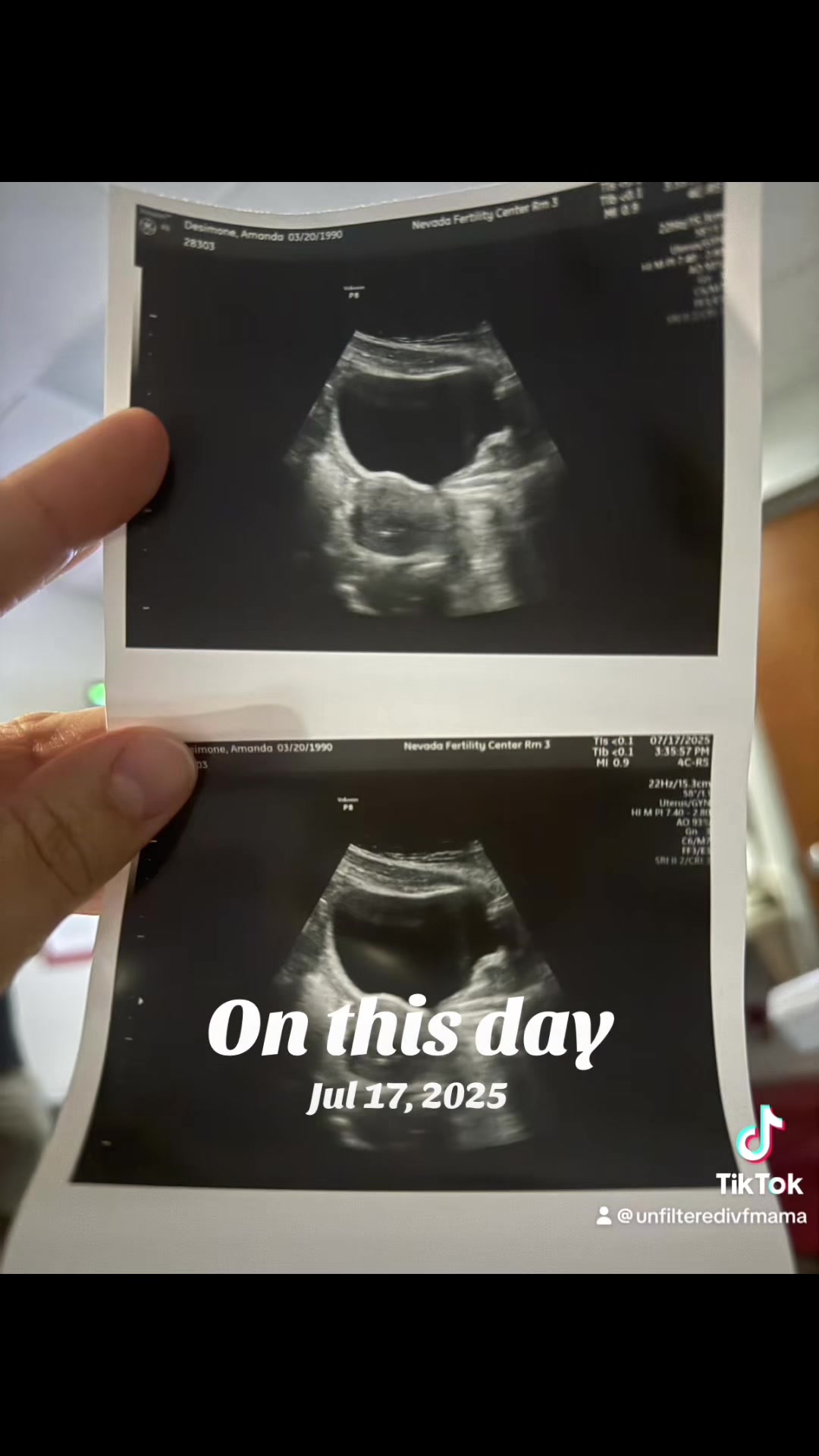 @Amanda | Unfiltered IVF Mama