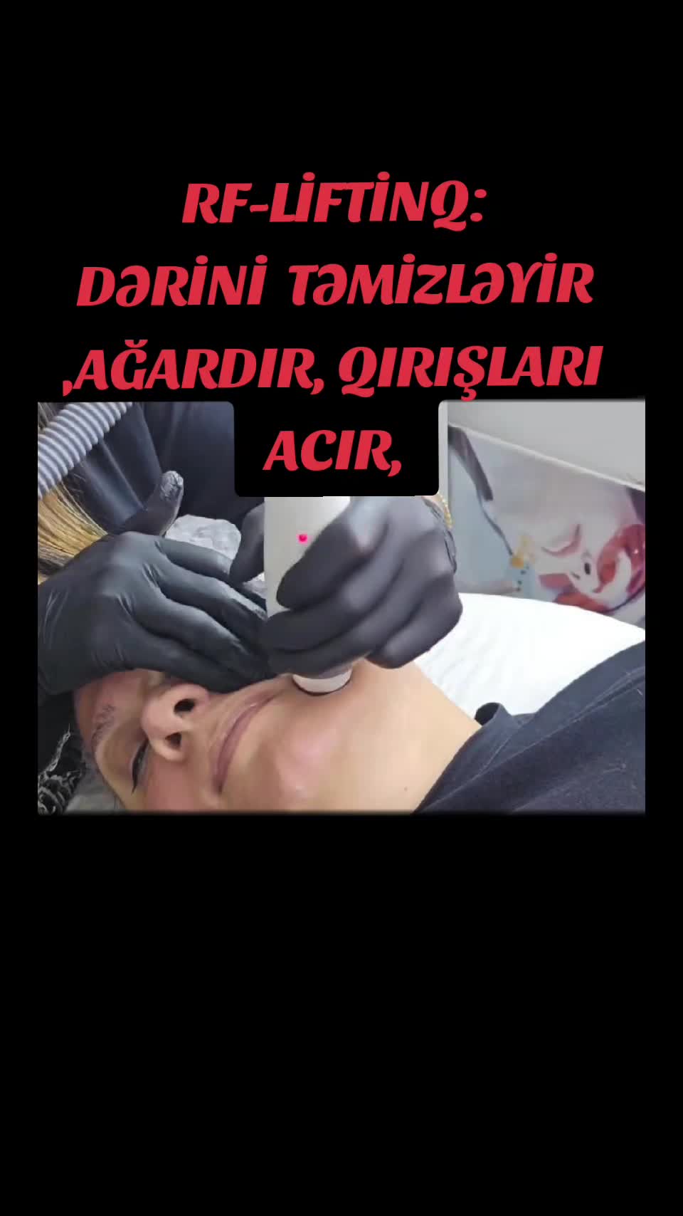 @ehmedli_kosmetoloq_lazeroloq