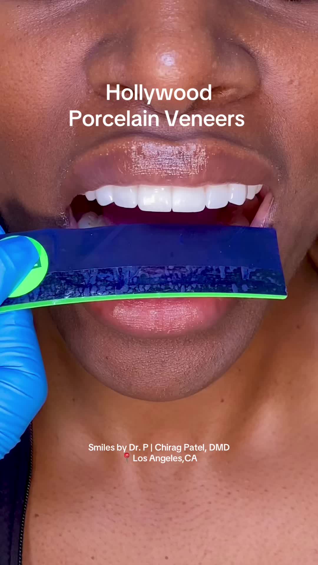 @Veneers