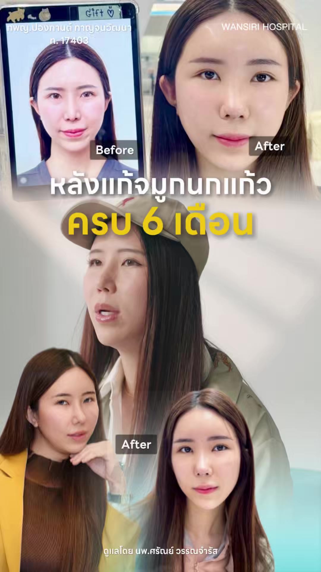 @หมอป่องสวยมาก veneer 🦷
