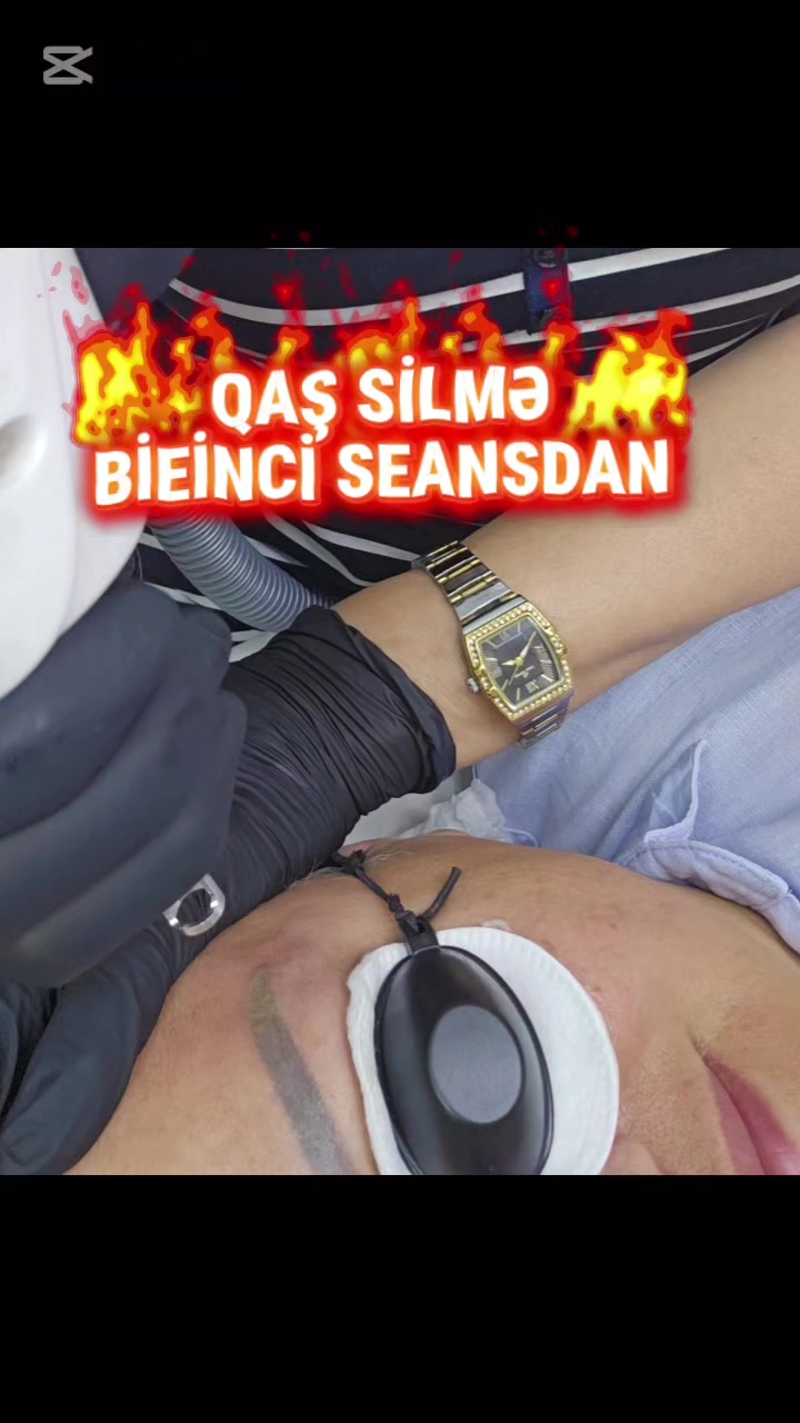 @ehmedli_kosmetoloq_lazeroloq