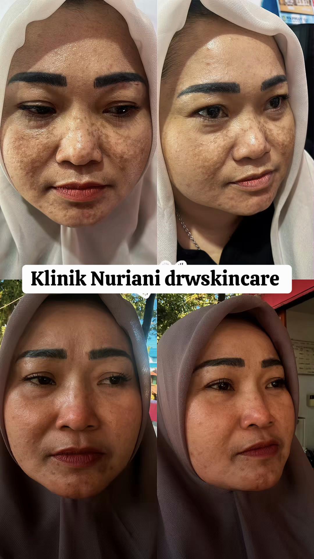 @Klinik drwskincare Sumut