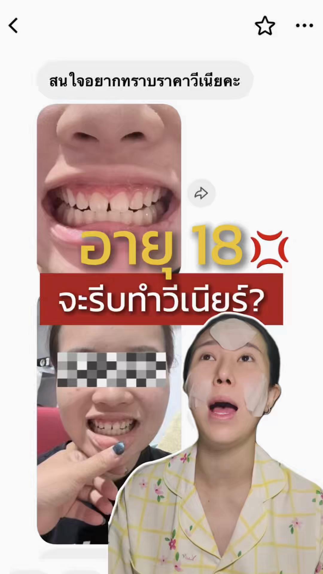 @หมอป่องสวยมาก veneer 🦷