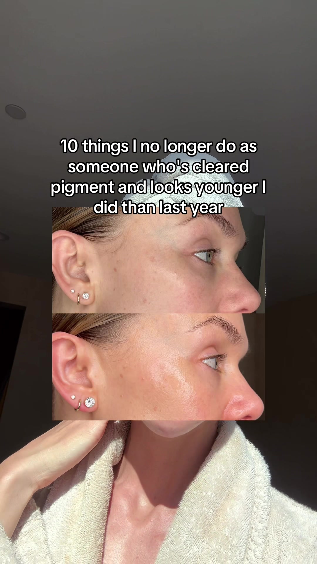 @Celeste | RN acne expert