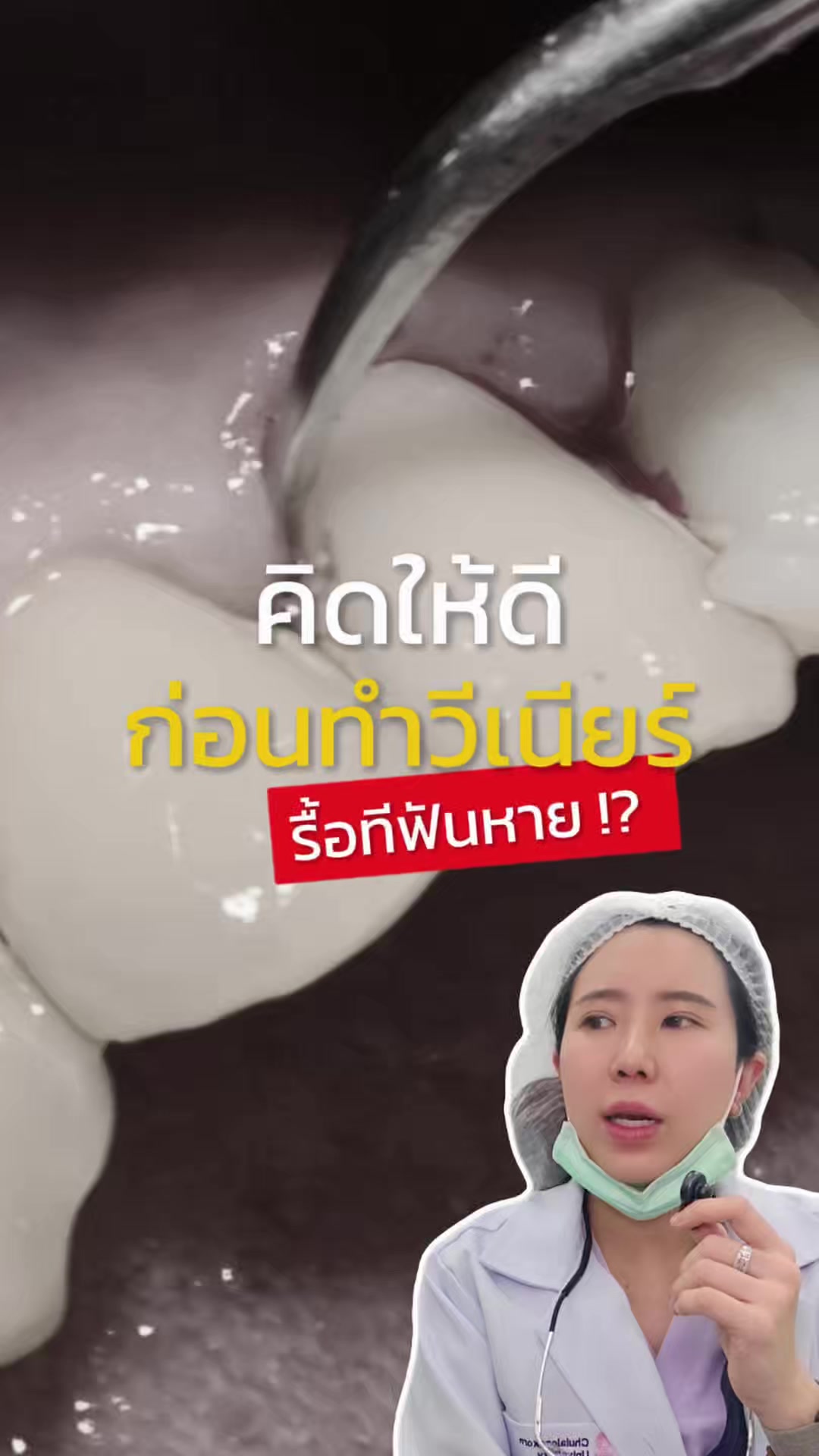 @หมอป่องสวยมาก veneer 🦷
