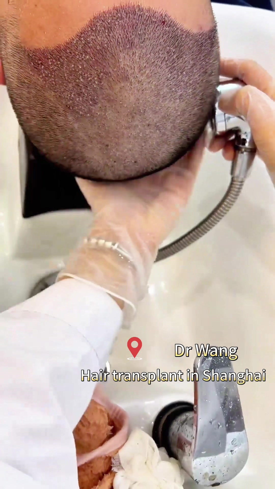 @HAIR TRANSPLANT WANG🇨🇳