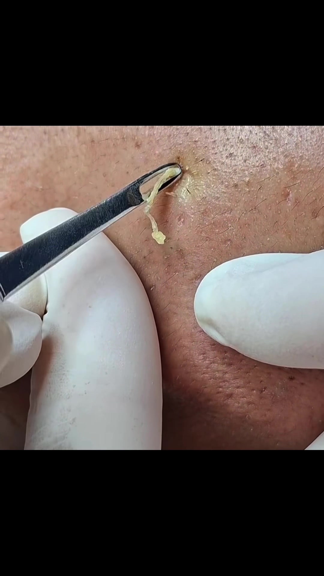 @pimplepopperasmr