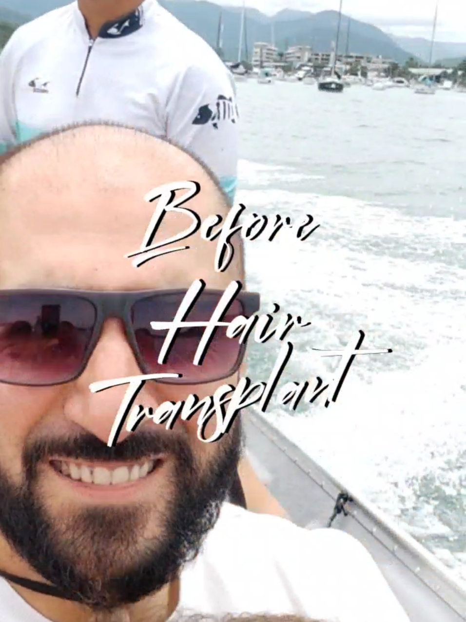 @My hair transplant