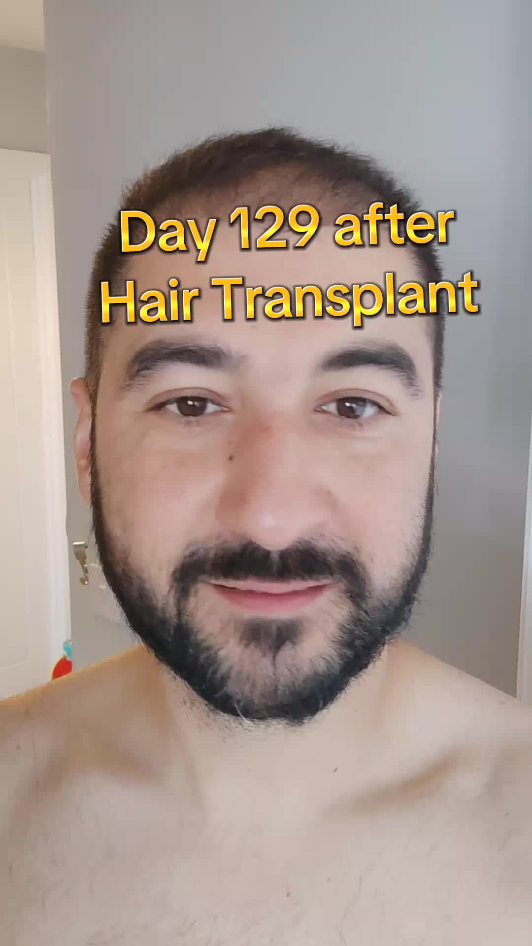 @My hair transplant