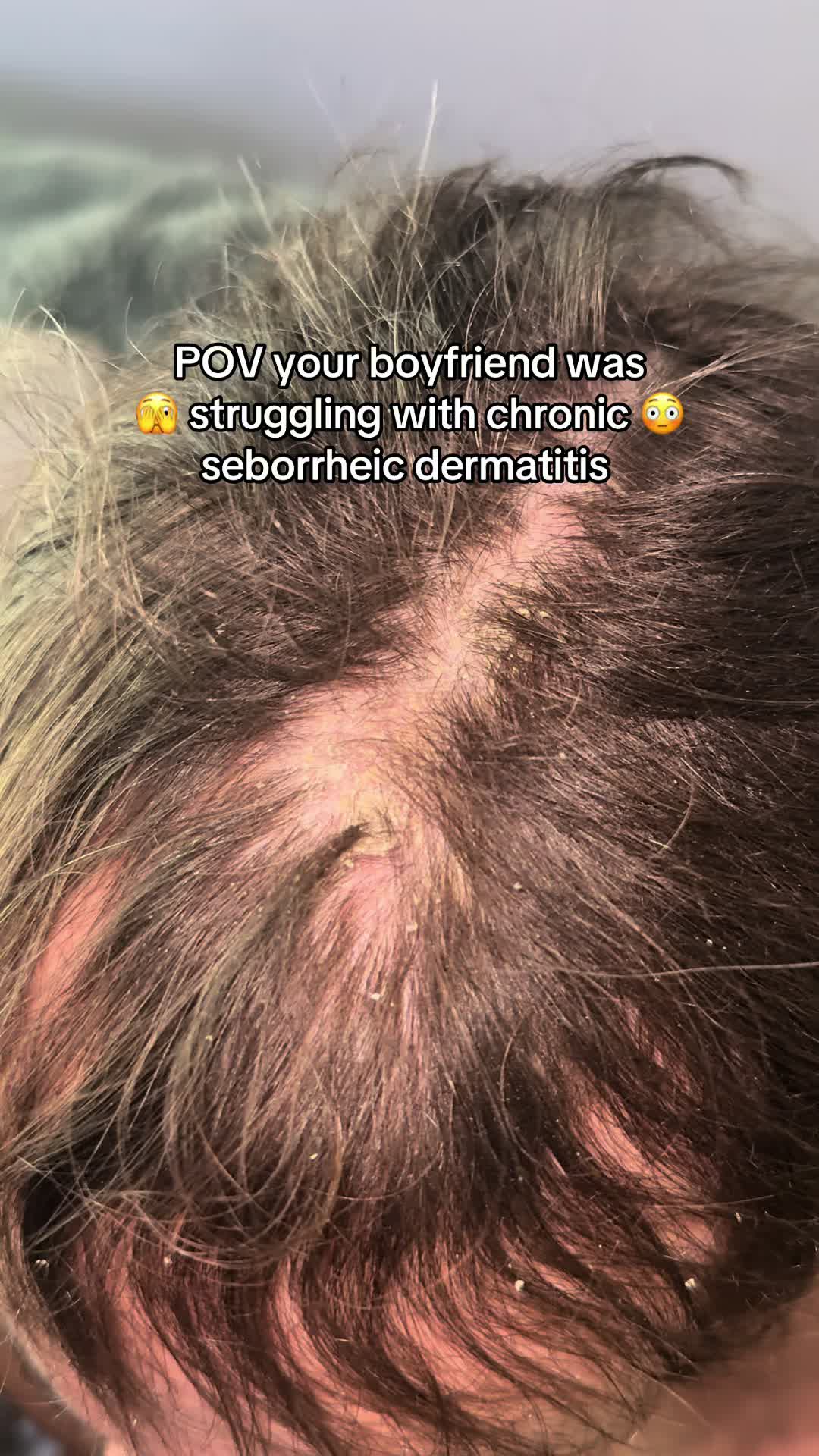 @Eczema Diaries USA & UK