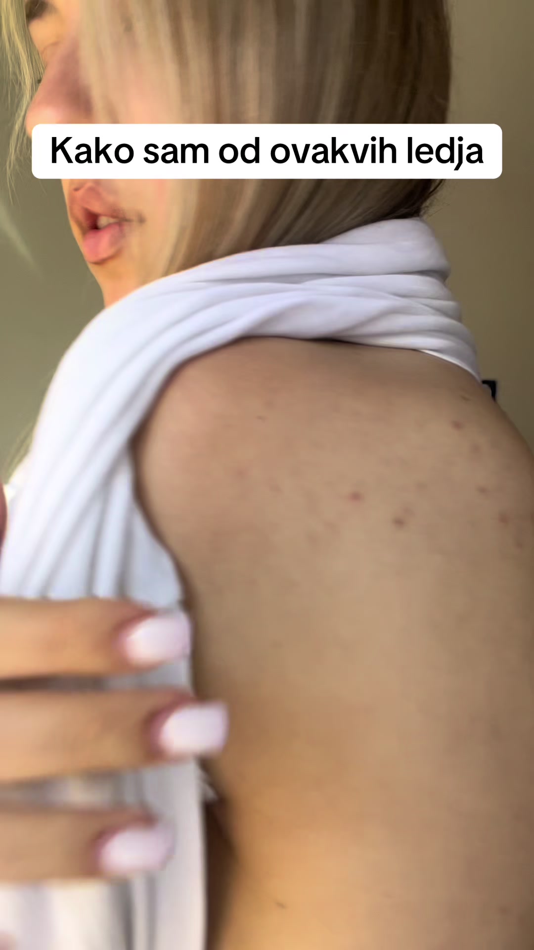 @obrisii.flekice