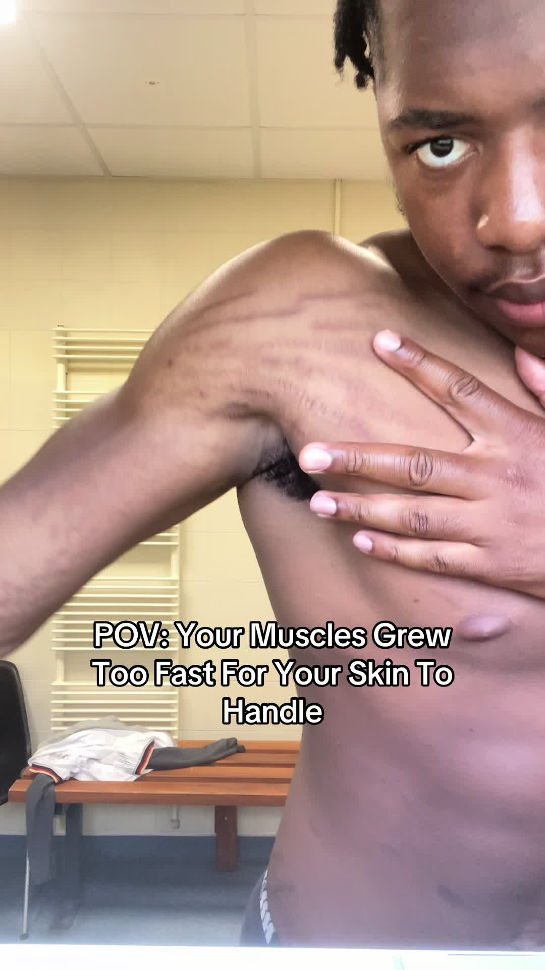 @Stretch marks guy