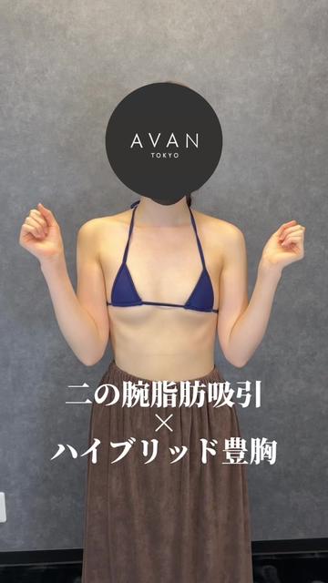 @森脇進/二の腕脂肪吸引・豊胸/AVAN TOKYO