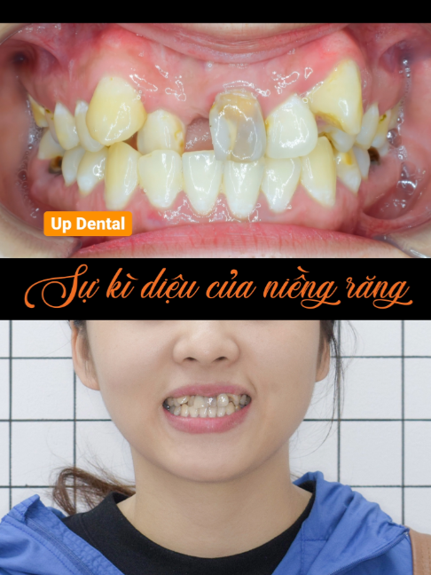 @Nha khoa niềng răng Up Dental