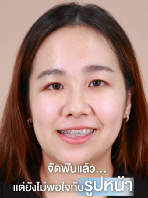 @โรงพยาบาลยันฮี