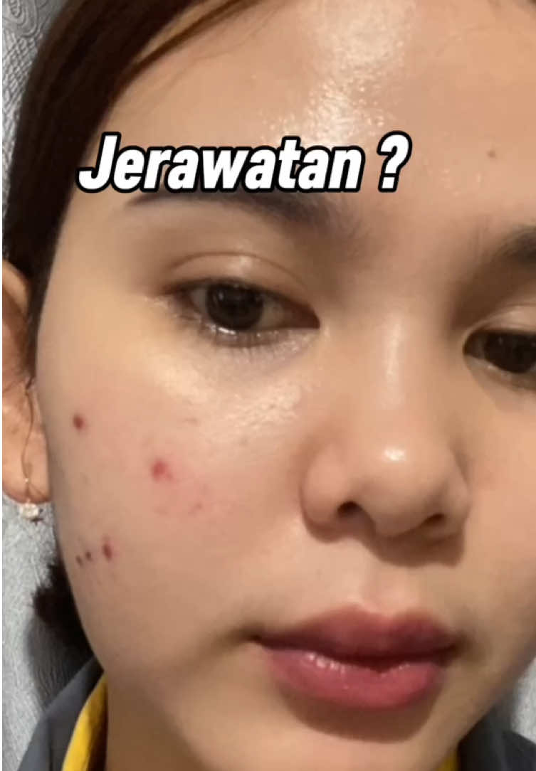 @Natha | Acne fighter