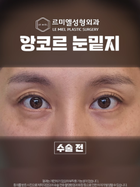 @르미엘성형외과