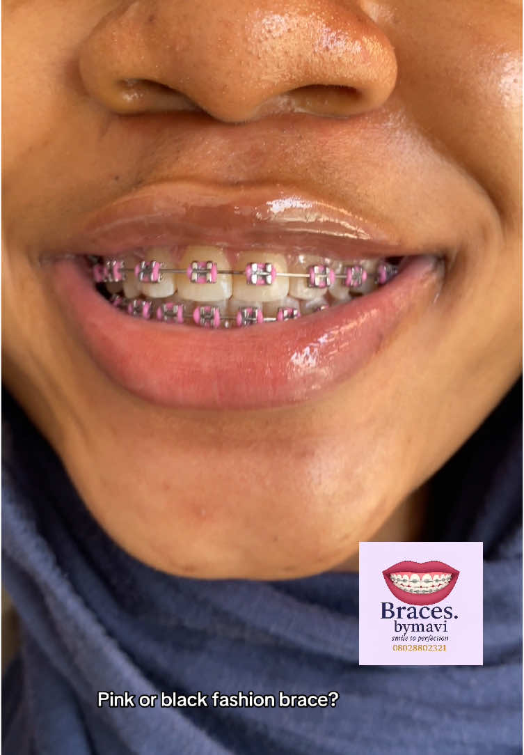 @Braces.bymavi|Smile Aesthetics