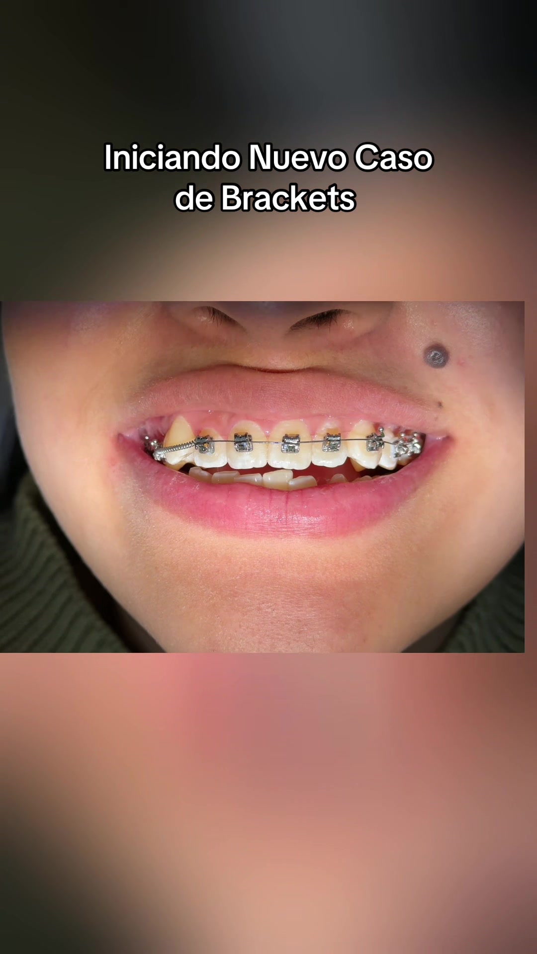 @DentikaBrackets