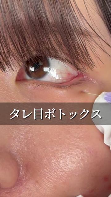 @高倉光平【タレ目形成×目尻切開】