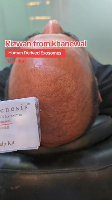@Dr Asad shalman HairTransplant
