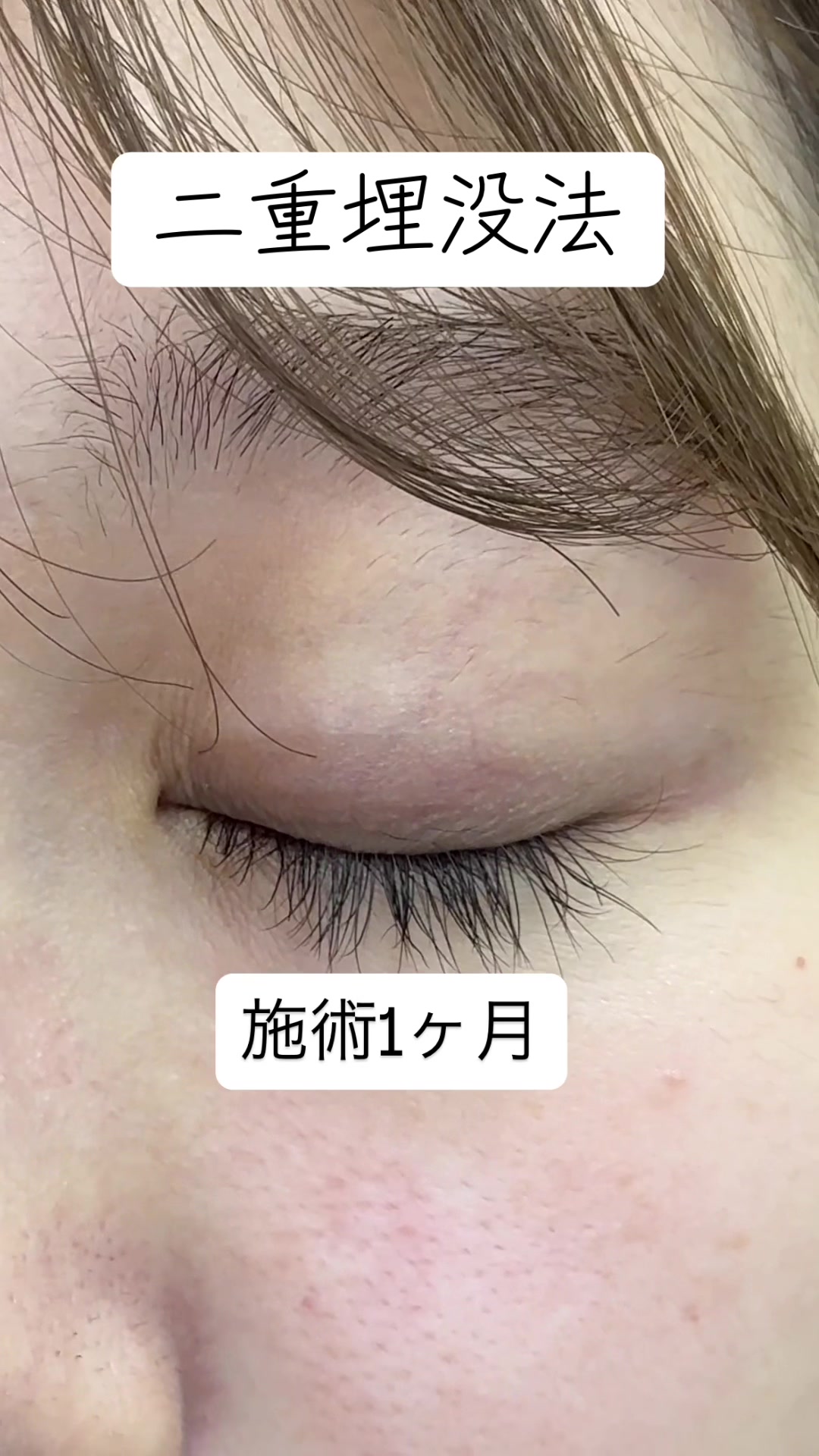@二重整形埋没法/広島美容外科メイプルクリニック院長 吉本如良