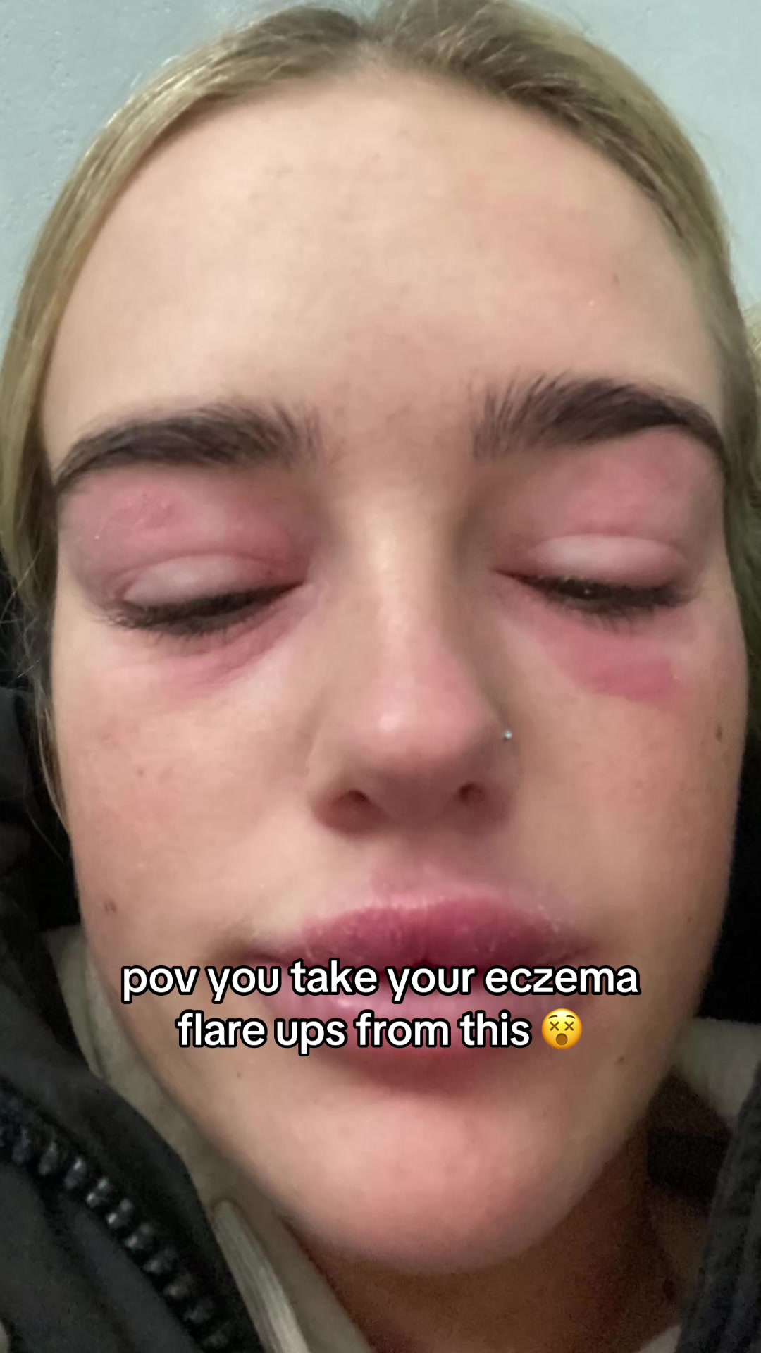 @Eczema Diaries USA & UK