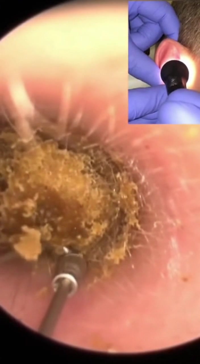 @Ear Cleaning