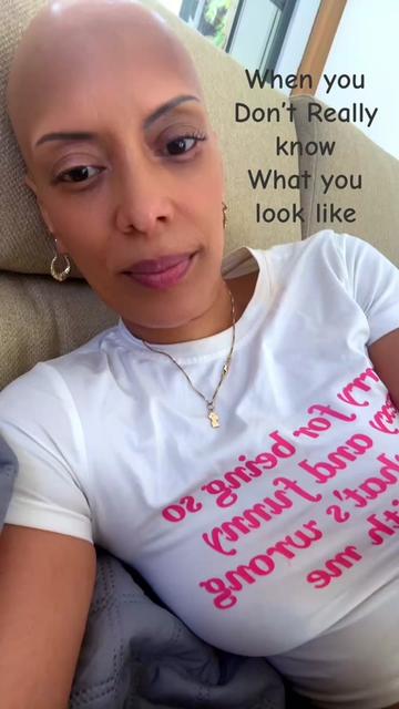@Action Jacklyn Alopecia