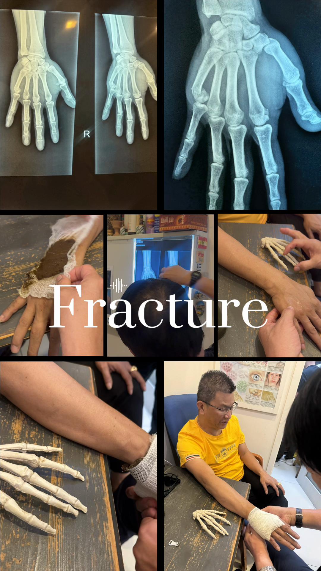 @Osteocare Bone Setting