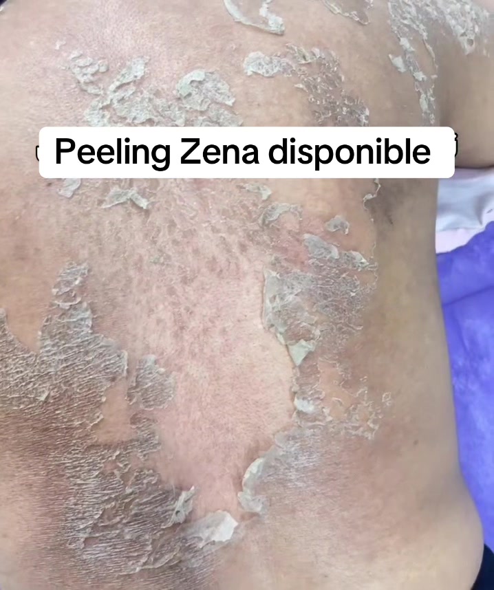 @peeling_zena